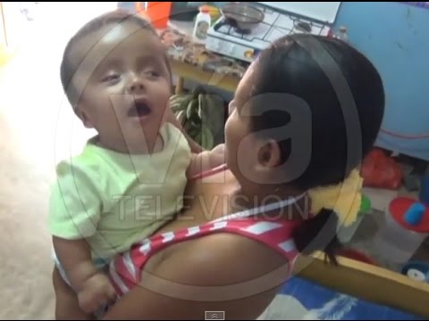 Transfieren a Lima a niño chazutino que padece hidrocefalia Transfieren a Lima a niño chazutino que padece hidrocefalia