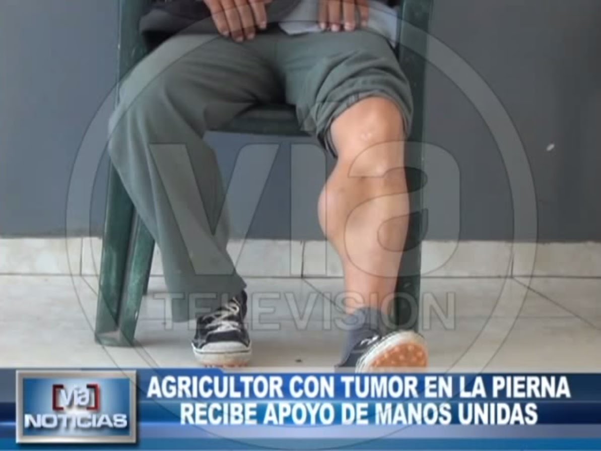 Agricultor con tumor en la pierna recibe apoyo de Manos Unidas Agricultor con tumor en la pierna recibe apoyo de Manos Unidas