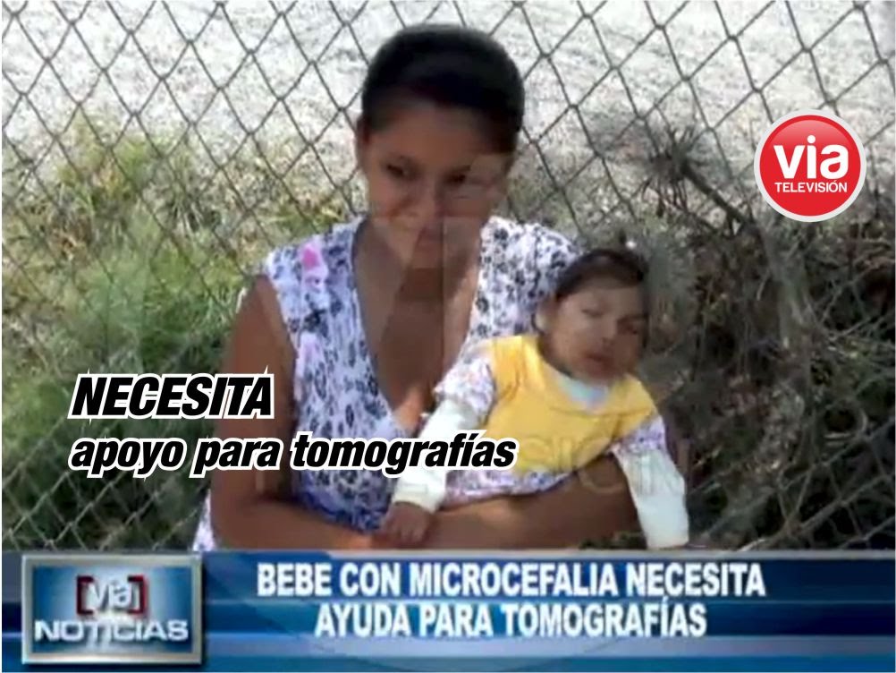 Bebé con microcefalia necesita ayuda para tomografías Bebé con microcefalia necesita ayuda para tomografías