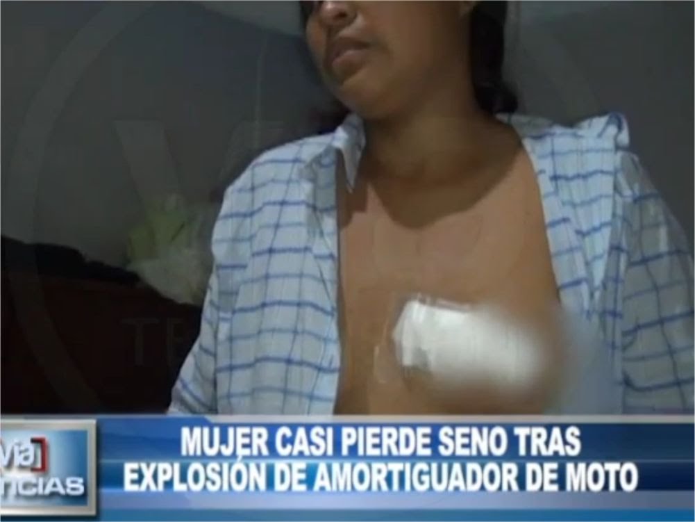 Morales: Mujer casi pierde seno tras explosión de amortiguador de moto Morales: Mujer casi pierde seno tras explosión de amortiguador de moto