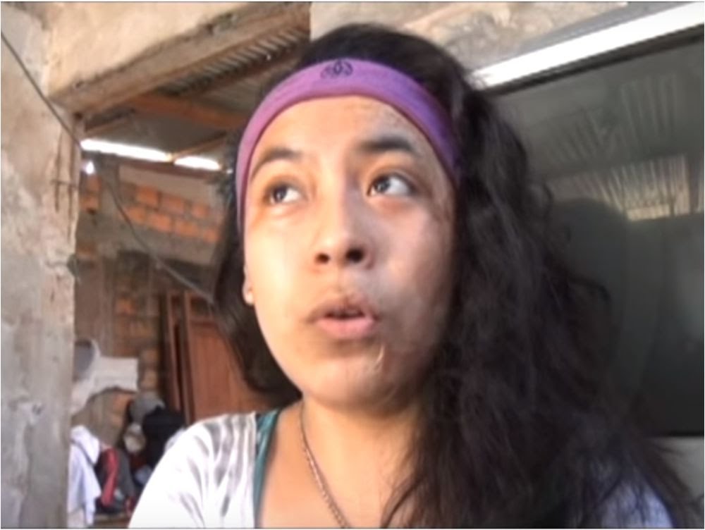 Joven que sufrió quemaduras regresó tras recibir tratamiento en los EE.UU Joven que sufrió quemaduras regresó tras recibir tratamiento en los EE.UU