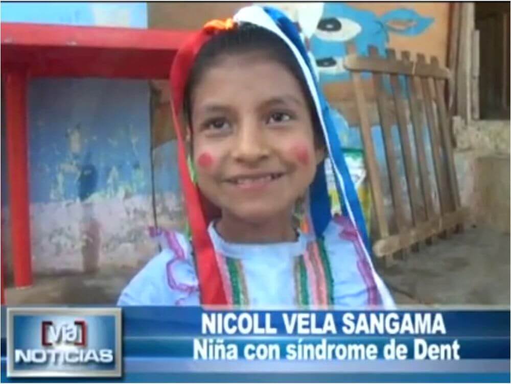 Niña lameña después de dos años supera el síndrome de DENT