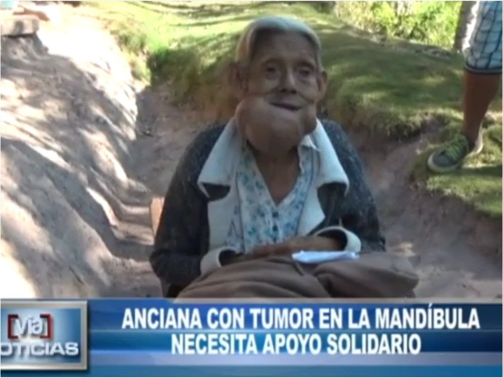 Anciana con tumor en la mandíbula necesita apoyo solidario Anciana con tumor en la mandíbula necesita apoyo solidario