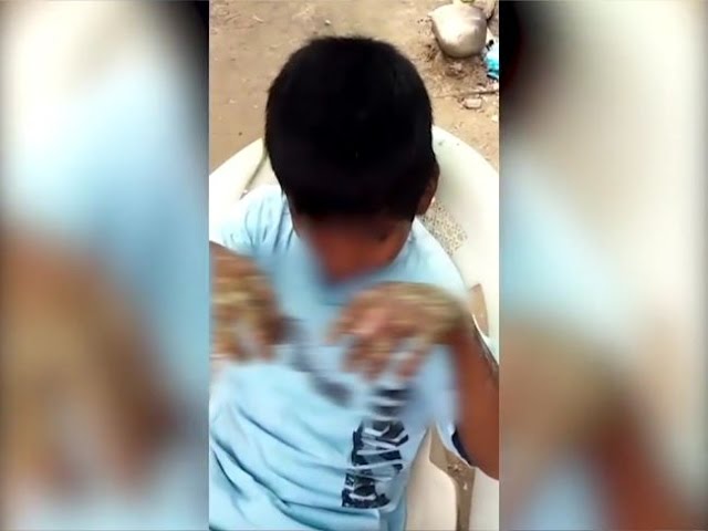 Niño que sufrió quemadura de manos necesita apoyo solidario Niño que sufrió quemadura de manos necesita apoyo solidario