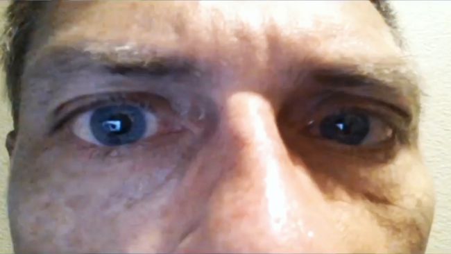 Tarapoto: se incrementan casos de conjuntivitis en hospitales del Minsa y Essalud Tarapoto: se incrementan casos de conjuntivitis en hospitales del Minsa y Essalud