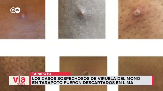 Los casos sospechosos de viruela del mono en Tarapoto fueron descartados en Lima