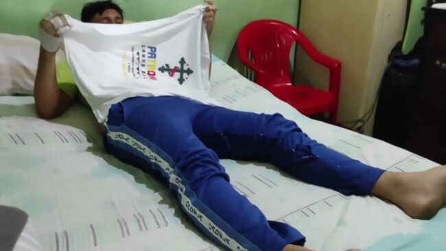 Universitario resulta con quemaduras de segundo grado luego que le rociaron ácido en el abdomen Universitario resulta con quemaduras de segundo grado luego que le rociaron ácido en el abdomen